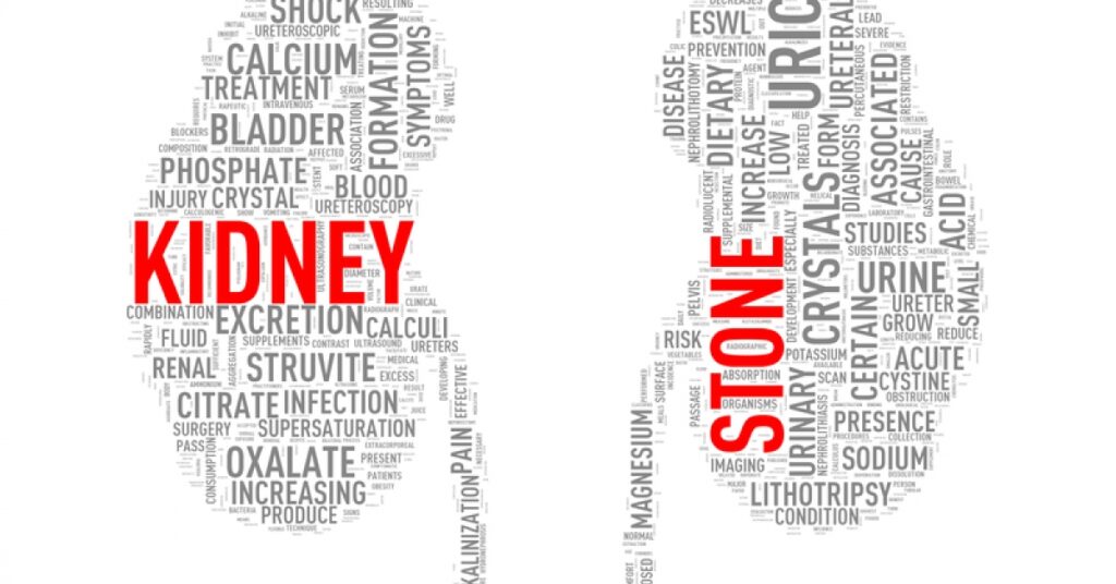 Everything you need to know about kidney stones | RxWiki