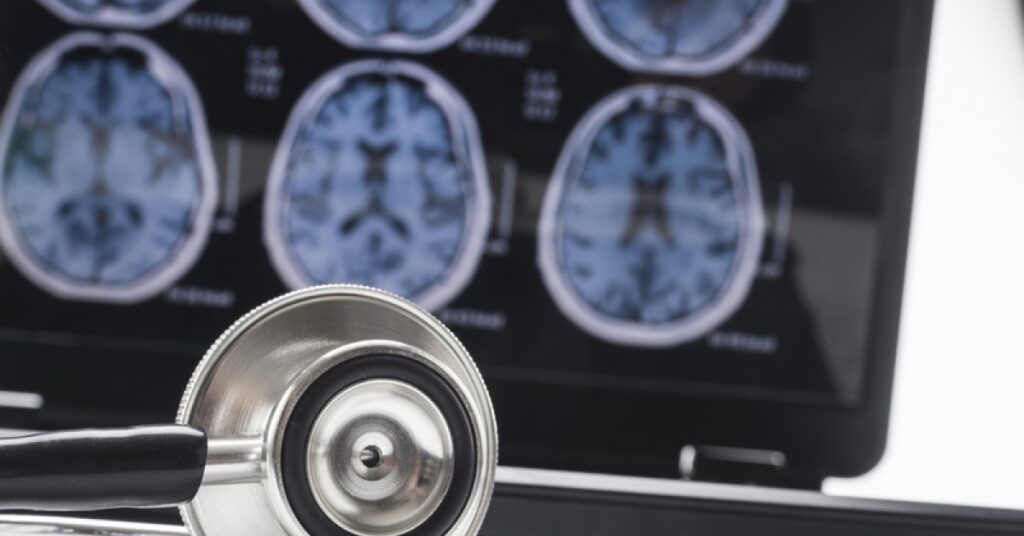 Here's what you need to know about Alzheimer's disease | RxWiki