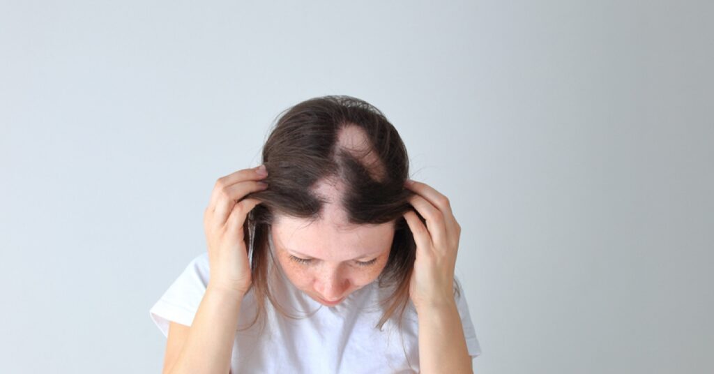 FDA approves Olumiant (baricitinib) oral tablets to treat alopecia areata | RxWiki