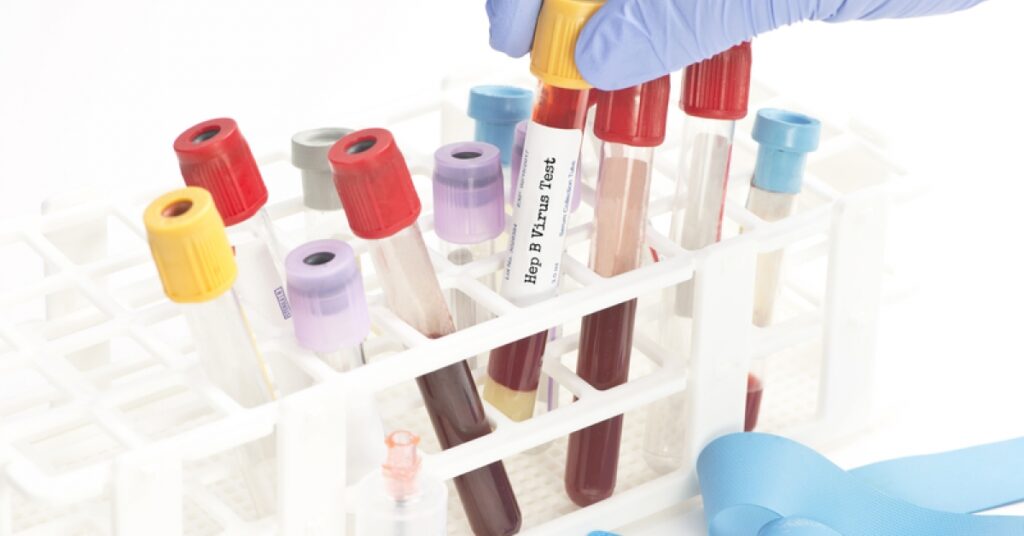 Hepatitis outbreak affecting kids still under investigation by health officials | RxWiki