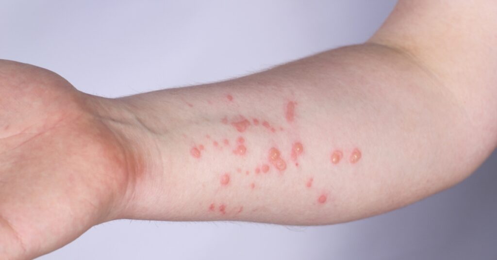 Where to get tested for monkeypox and when | RxWiki