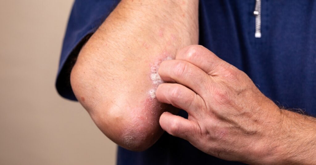 FDA approves Sotyktu (deucravacitinib) to treat plaque psoriasis  | RxWiki